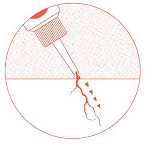 Creeping Crack Cure