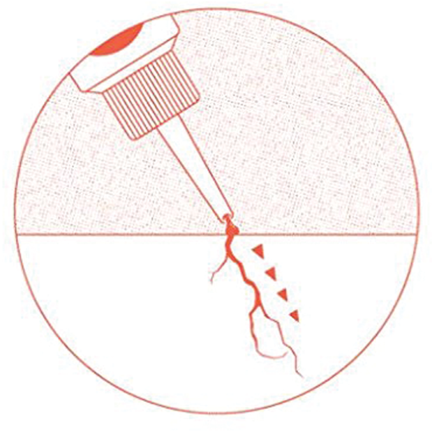 Creeping Crack Cure